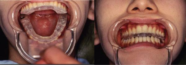 Figure 6 (Oral dyskinesia Case-2): Wearing a Bite plate. Figure 10 (Oral dyskinesia Case-2): Premature contacts.