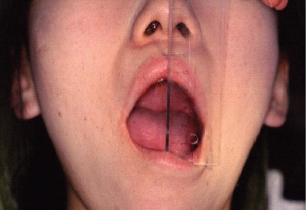 position. Figure 7 (Oral dyskinesia Case-2): Releaving symptoms.