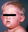 Describe pathogenesis of measles and the immune system 4. Describe the epidemiological characteristics of measles 5.