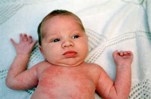 Measles Very contagious infection caused by paramyxovirus group Symptoms: fever, cough, runny nose, conjunctivitis, Koplik