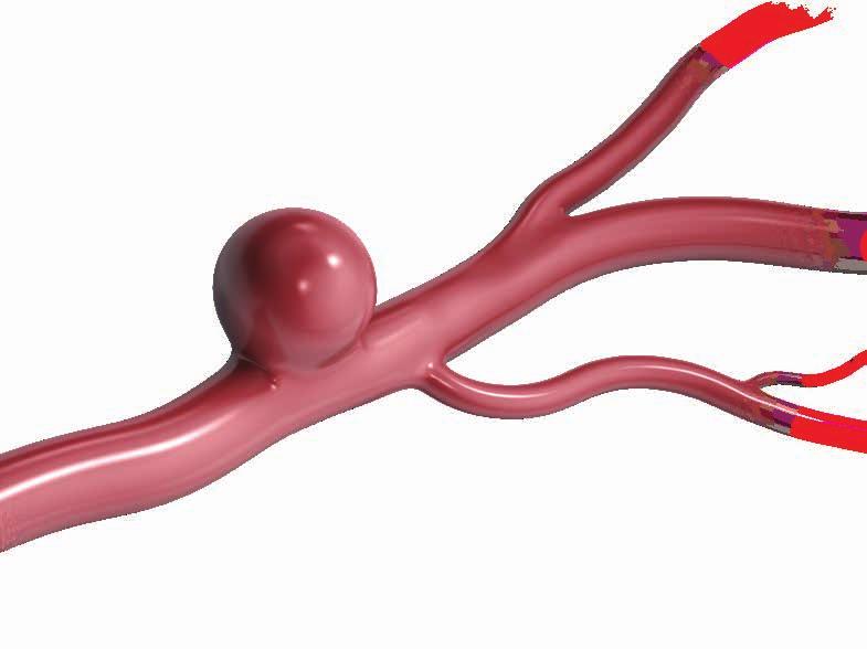 A wide-neck aneurysm is a type of saccular aneurysm with a neck that is 4mm or wider, or is at least half as wide as it is high.