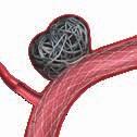 When blood flow to an aneurysm is slowed and eventually eliminated, the aneurysm begins to shrink.