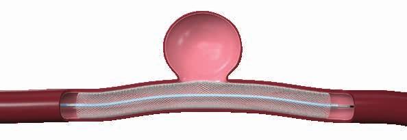The Surpass Streamline Flow Diverter is a small braided tube made from a material called cobalt chromium and is implanted adjacent to the neck of the aneurysm, allowing for restoration of the vessel