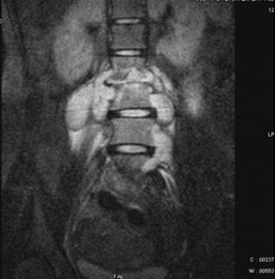 Figure 3 Contiguous involvement of vertebral body with paraspinal soft