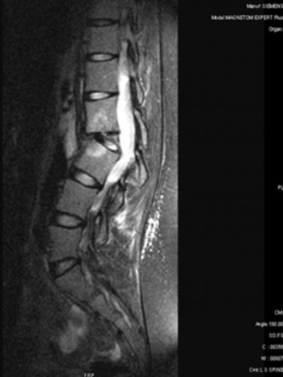 Figure 9 Figure 10 T2 weighted sagittal image showing involvement of CV Joint.