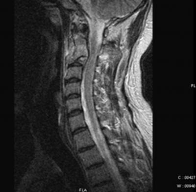 Figure 11 Bone destruction and Gibbus-short segment kyphotic deformity are common sequelae of tuberculosis of spine.
