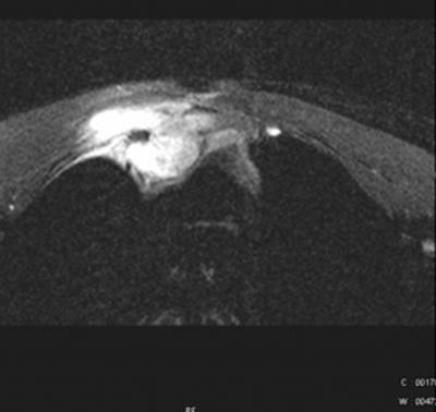 Figure 12 Sternoclavicular Joint swelling may show soft
