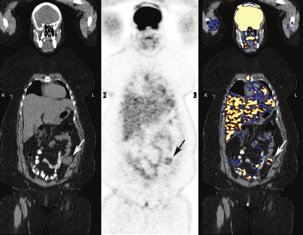 (c) Figure 1. (Cont.) (c) Coronal PET-CT images (from left to right: CT, PET and fused PET/CT images) show mild increased FDG uptake in the left transposed ovary (arrows).