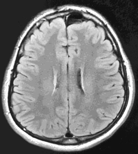 brain tissue may herniate into a diastatic