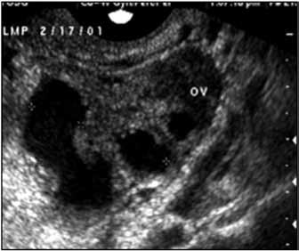 Figure 3 Tubo-ovarian complex T. The tube (T) and ovary (OV) form an infectious conglomerate.. Power oppler appearance.. Laparoscopic view.