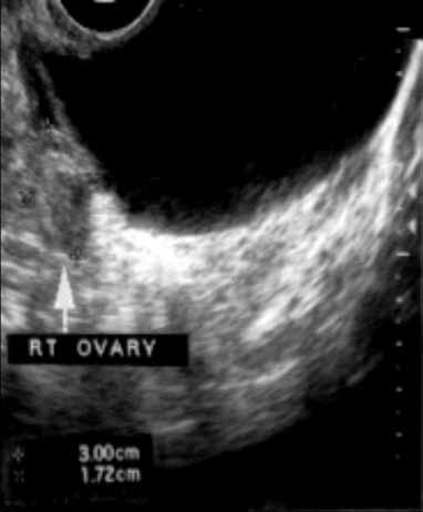 Tubo-ovarian abscess is a more advanced stage of a fast-progressing or neglected pelvic inflammatory process.