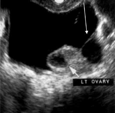 In ovarian torsion, the follicles press outward lthough torsion has distinct sonographic signs, it remains a clinical diagnosis that US findings may or may not support.