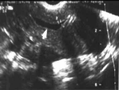 Figure 7 Fallopian tube cancer. Fluid-filled uterine cavity.. Large cystic dilatation of the tube.. thickened tubal wall (arrow).. oppler interrogation reveals high diastolic flow (arrows).