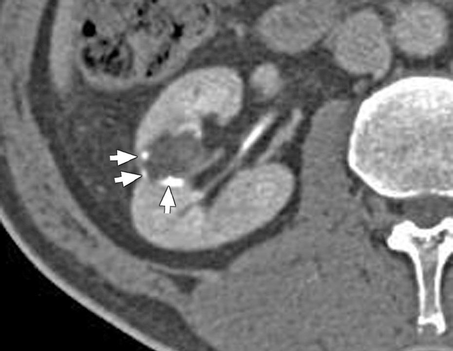 thickening, calcification or contrast enhancements (Fig. 3). Category II: Cystic masses show a thin septa (< 1 mm) or fine calcifications, or appear as hyperdense cysts.