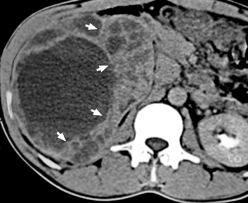 7 Clear cell-type renal cell carcinoma with central necrosis in the left kidney. Axial contrast-enhanced CT image shows a large, inhomogeneous enhancing mass with central necrosis in the left kidney.