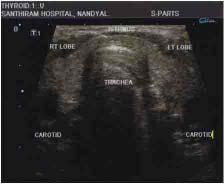 Ultrasound Evaluation of Thyroid Lesions