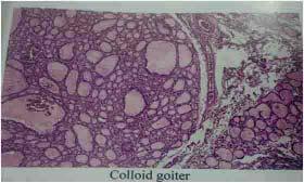 Colloid goiter Figure 3: Colloid nodule with