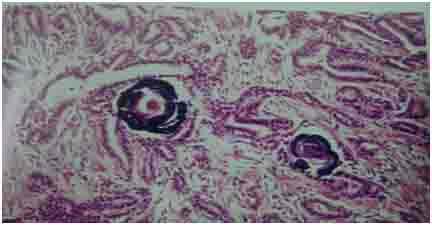 of papillary carcinoma Figure 11: Histopathological picture of Hashimotos thyroiditis mixture