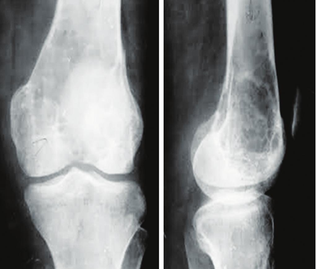Figure 1a, b: Giant cell tumor with ABC of lower end of femur. (c) (d) Figure 1c, d: Giant cell tumor talus with ABC.