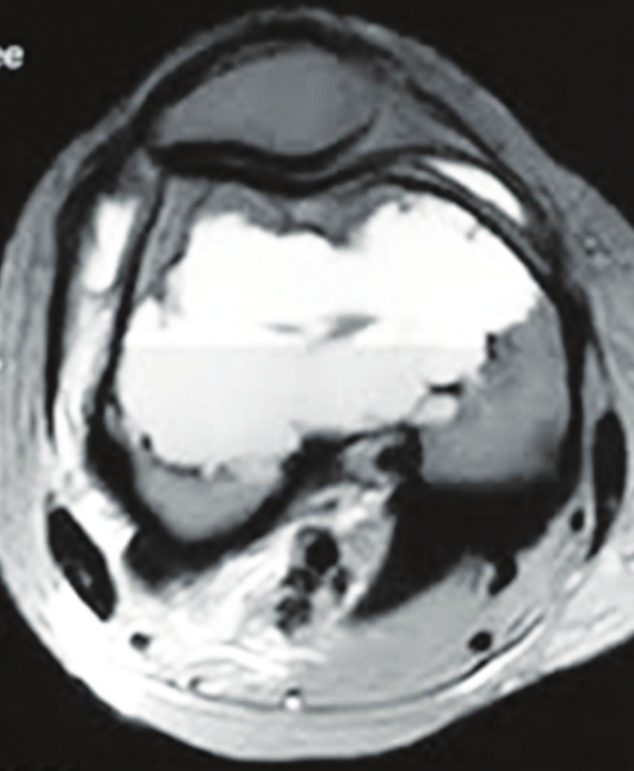 Chondroblastoma comprises 1-3% of primary bone tumors, occurring in patients between 10 and 20 years of age, and is more prevalent in males [9].