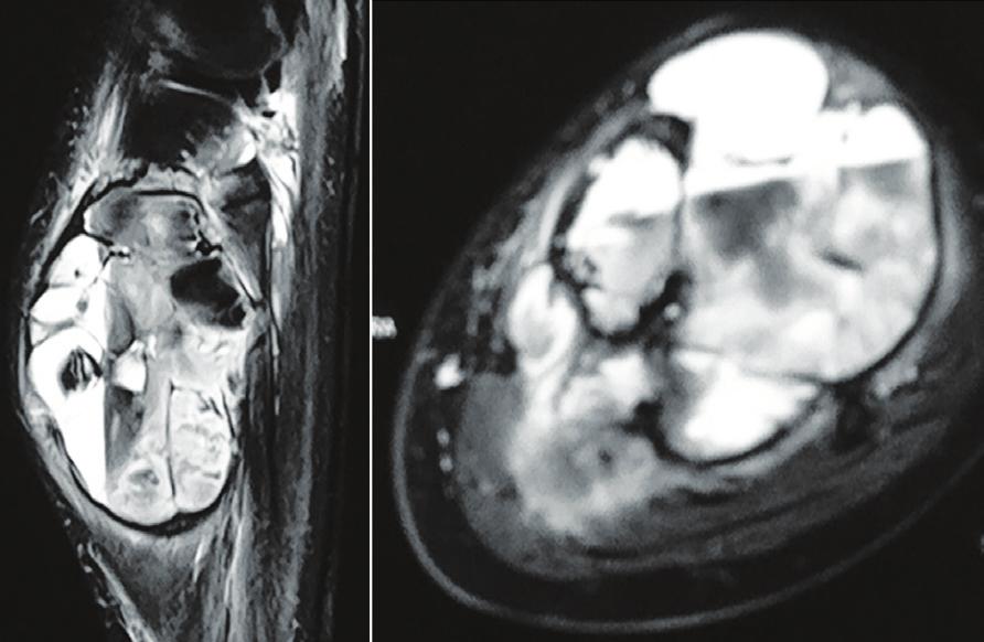 Primary arises from the central medulla with a lytic lesion containing calcifications. Secondary chondrosarcoma arises from peripherally situated enchondroma or osteochondroma.