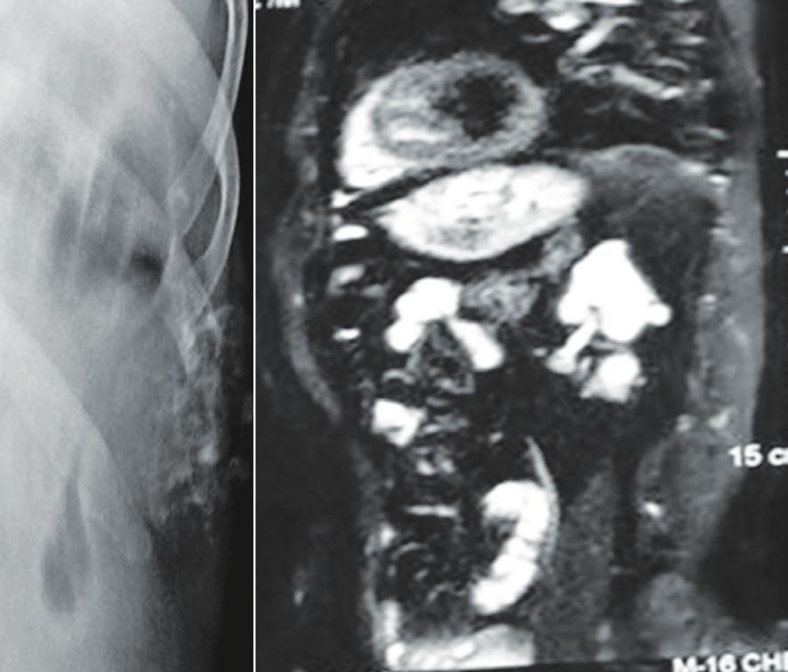 Figure 5a, b: 70 M, chondrosarcoma of rib with FFL. Figure 6a, b: Plasmacytoma with FFL. Figure 7a, b: MFH of soft tissues of the arm with ffls (arrows).