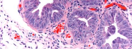 cells from the tubal carcinoma on to the ovary (Lancet 2001; 358:844) 1998 2001 2003