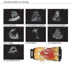 FAST : Sonography Screening in Major Trauma Patients Quick evaluation of intraperitoneal cavity and pericardium