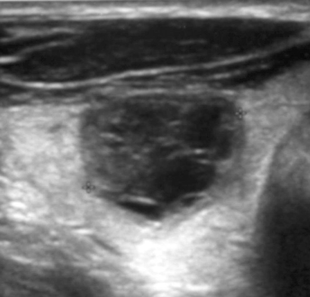 However, US-guided PEIs failed to obliterate the cystic portion of the four thyroid nodules (4.7%; two nodules in Group A and two nodules in Group B).