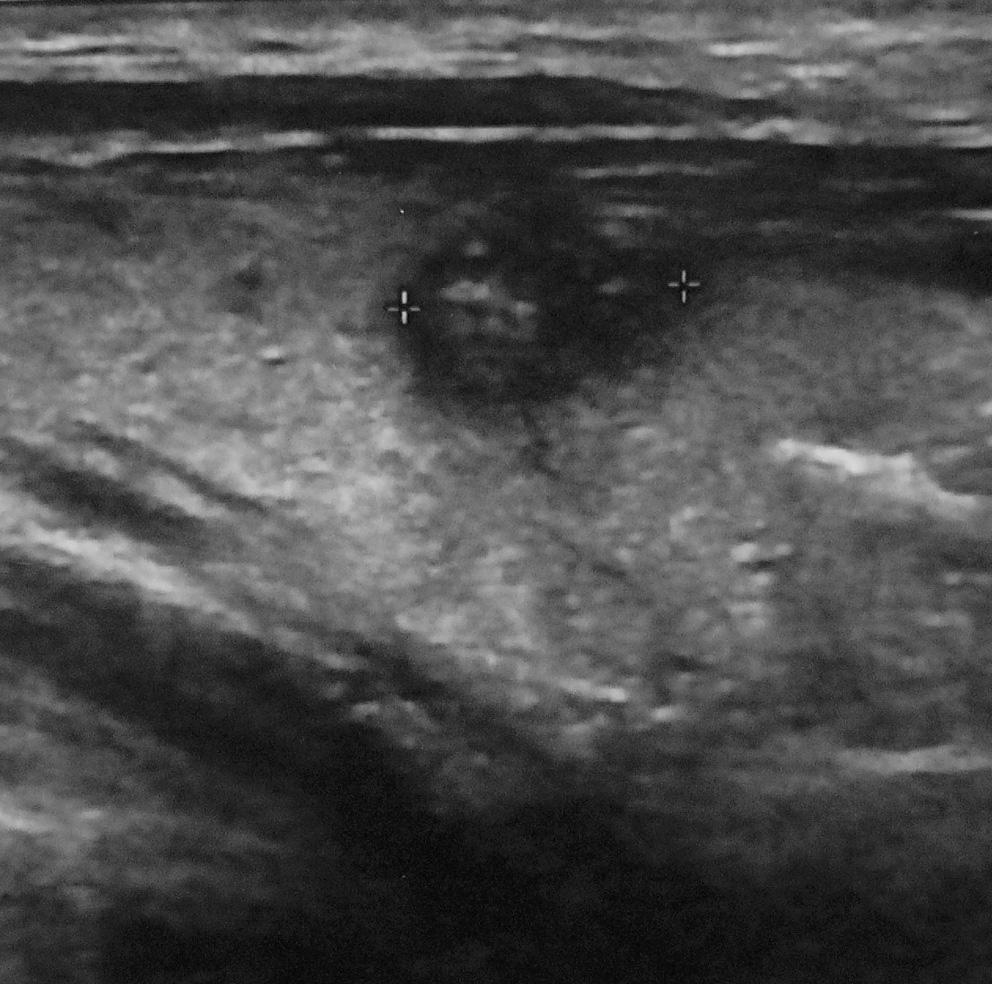Two or more of the five sonographic criteria were detected on US in 13 (50%) and 32 cases (53.3%), respectively. One or more of the five sonographic criteria were revealed by a US in 14 (53.