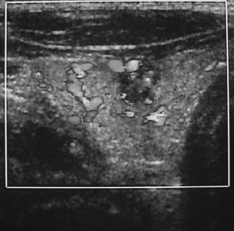 The results indicates a high incidence rate of five sonographic criteria in the sclerosed thyroid nodules in the two groups, and there was no statistical difference in the incidence rate of