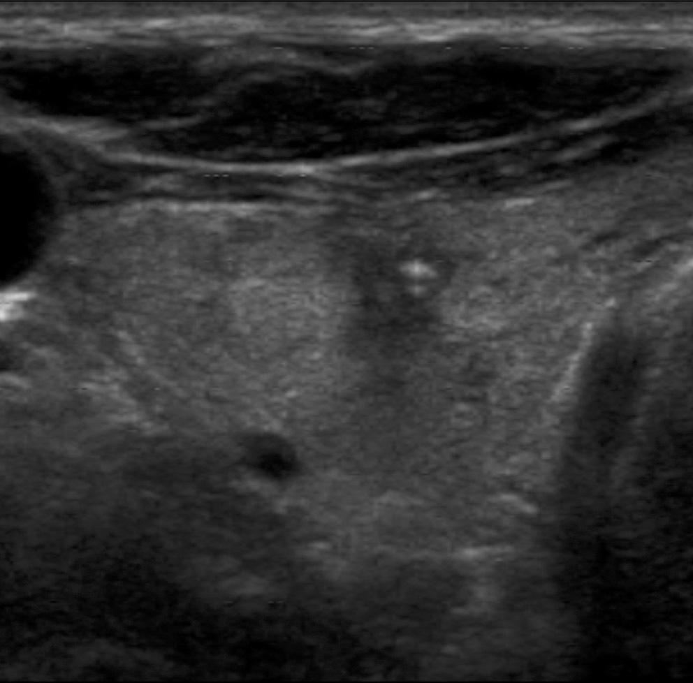 55-year-old man with a cystic thyroid nodule in the right lobe. A. A transverse US obtained before sclerotherapy shows a pure thyroid cyst filled with colloid material. B.