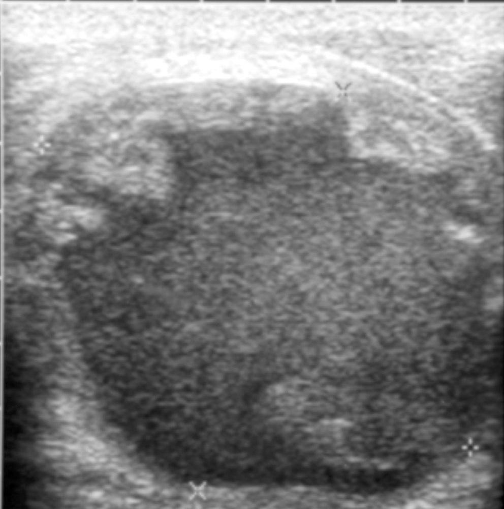 Ji Sung Park, et al : Long-term Follow-up Sonography of Benign Cystic Thyroid Nodules after a Percutaneous Ethanol Injection Discussion Instead of the surgical removal of