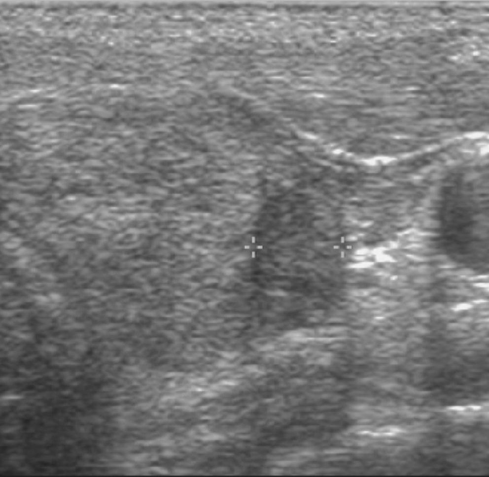 A transverse US obtained 3 months after sclerotherapy reveals a complete disappearance of the previous cystic portion of the thyroid nodule filled with a non-vascularized,