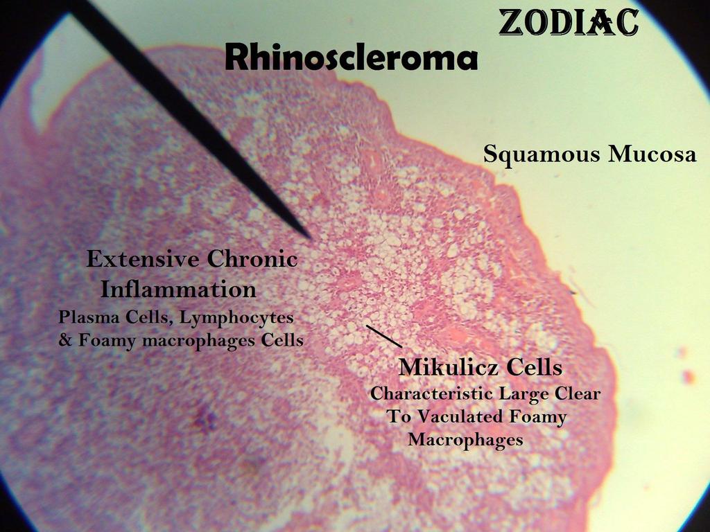 Special sense 1- Rhinoscleroma Mucosa There is extensive chronic inflammation with