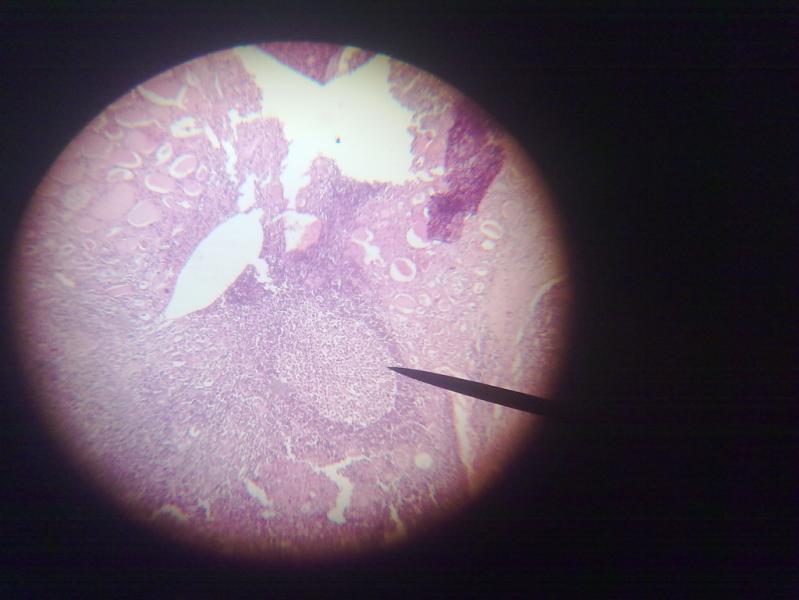 Follicles Small sized follicles lined by tall columnar epithelium and