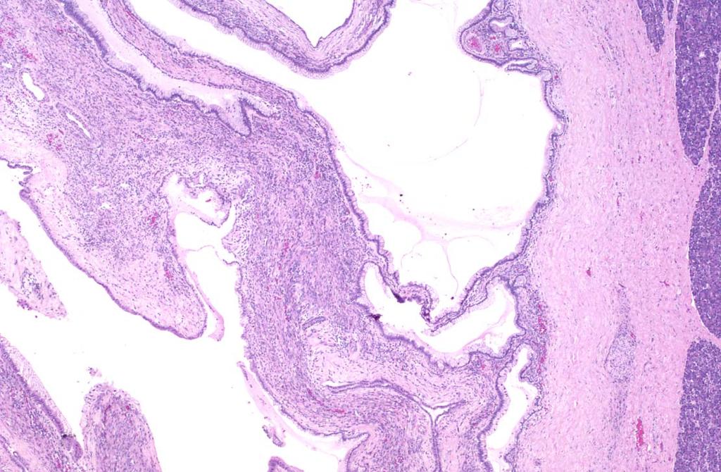 system Cysts lined by mucinous,