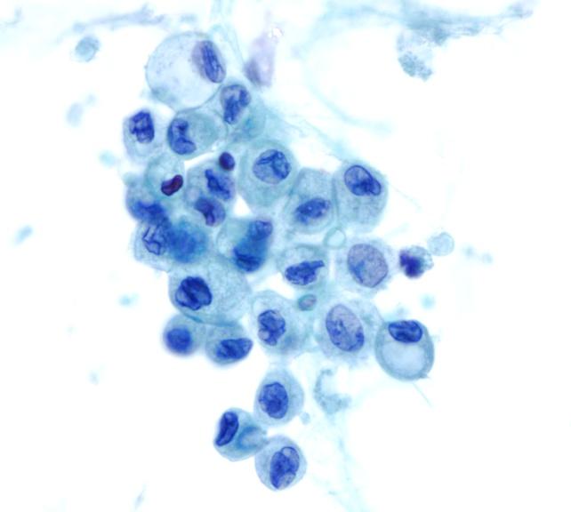 Cytology of Neoplastic Mucinous Cysts (MCN or IPMN) LGD MD At least CIS