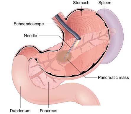 Aspirates of masses in pancreatic head are performed through