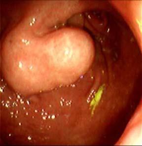 bulging of the GI wall with intact, normal, overlying mucosa.
