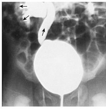 Voiding cystourethrogram in an infant boy with a past history of a urinary tract infection.