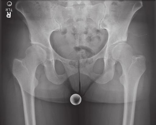 Lewis MD, 2 Steven A Olson MD ABSTRACT The Bernese periacetabular osteotomy (PAO) is a powerful technique for correcting acetabular coverage in patients with developmental dysplasia of the hip.