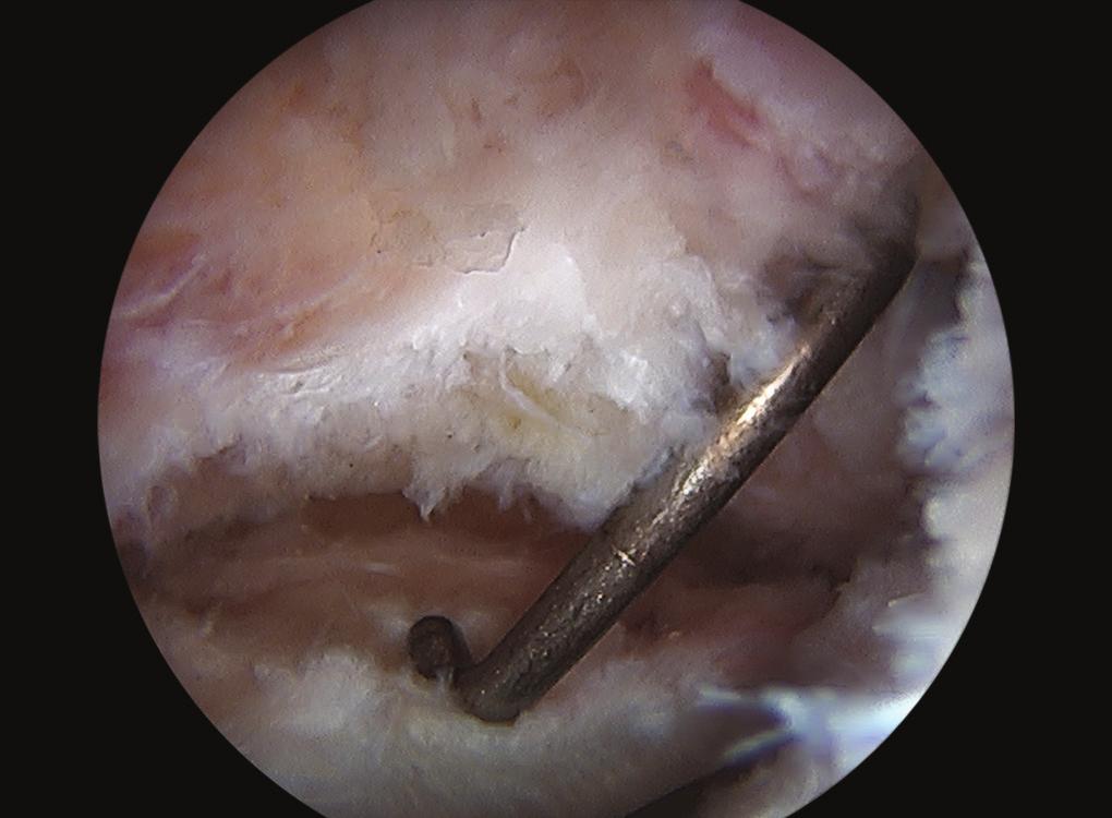 A spinal needle is then used to establish the modified anterior portal (AP). A long handle double-sided blade (Stryker, Kalamazoo, MI, USA) is used to create the interportal capsulotomy.