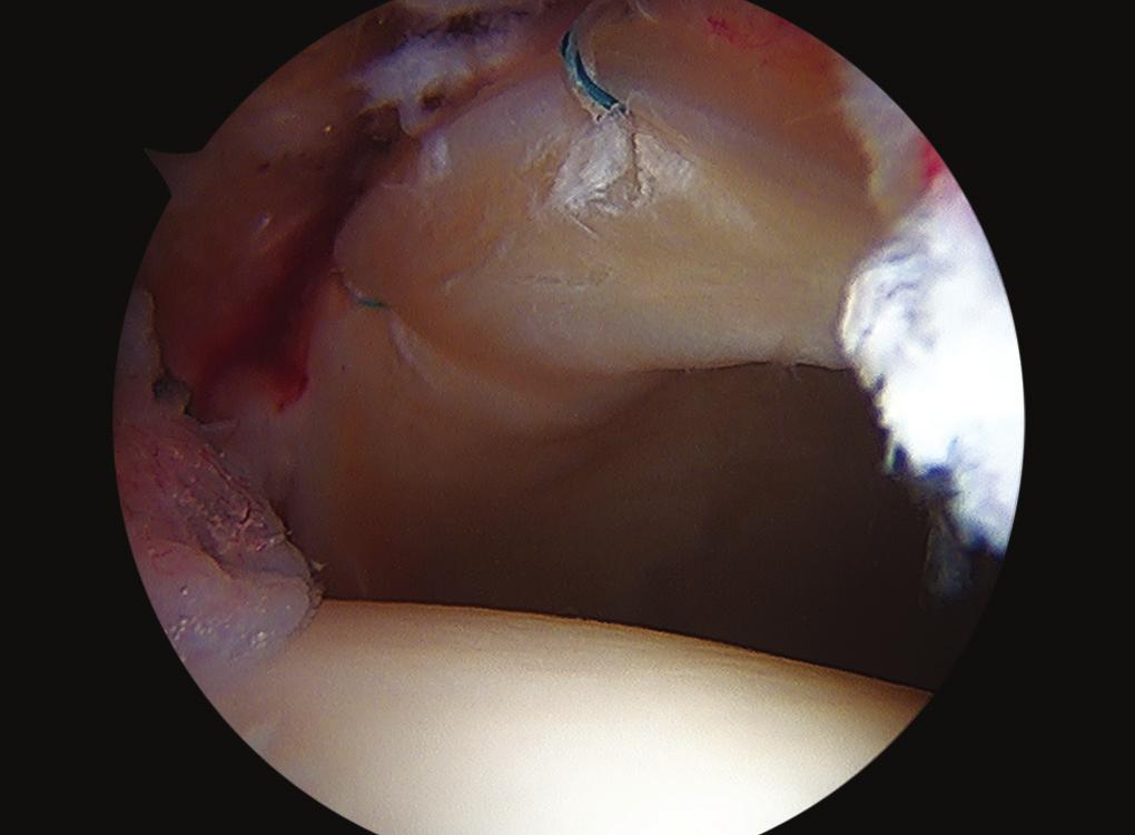 Retention sutures are then placed in the medial and lateral ends of the proximal capsule using a suture-passing device (Stryker, Kalamazoo, MI, USA).