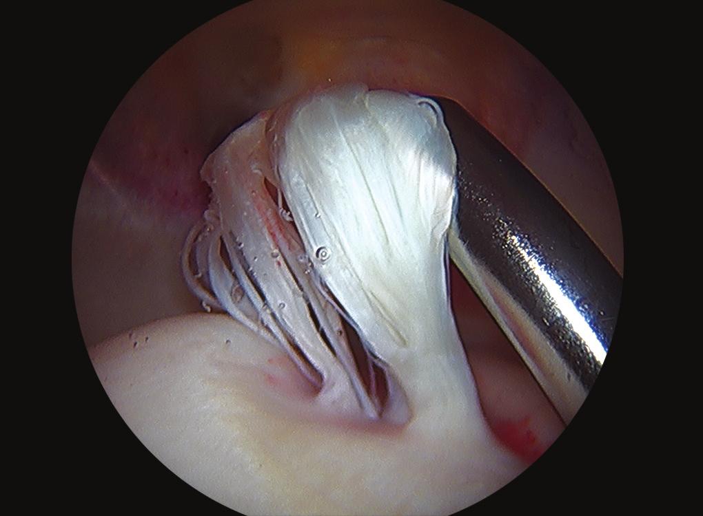 In dysplastic patients, the labrum is often hyperplastic with evidence of chondrolabral disruption (Figs 2 and 3). If torn and/or unstable, labral repair is performed.