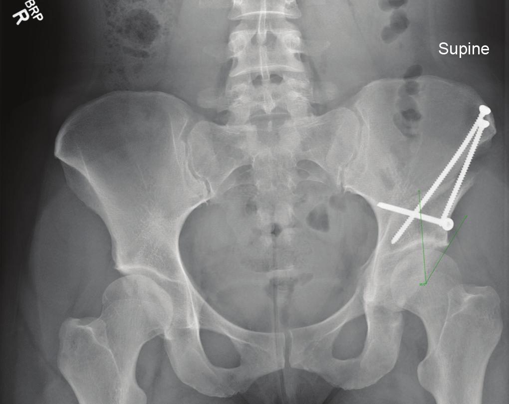 DOJ Technique for Combined Hip Arthroscopy and Periacetabular Osteotomy for the Patient A B C D E Figs 6A to F: Flouroscopic images demonstrating the order of acetabular cuts: (A) Incomplete ischial