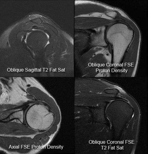 Normal Shoulder MRI Coronal
