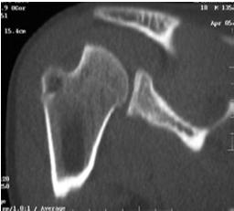 recurrence rate Osseous Defects/Deficiency Humeral Side Impression fracture (Hill-Sachs