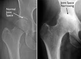 Fig. 10b Intraoperative hip arthroscopy photograph showing changes of osteoarthritis with significant articular cartilage damage on the