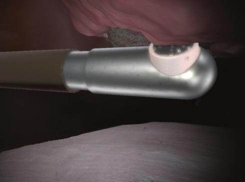 Insert an ablation wand and use the left pedal to ablate soft tissue and expose the undersurface of the acromion.